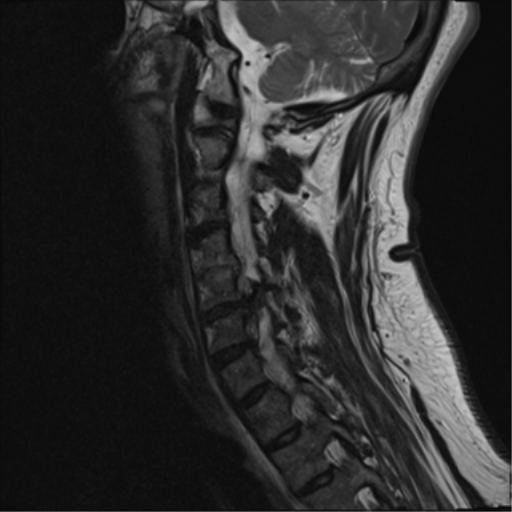File:Cervical canal stenosis due to ossification of the posterior longitudinal ligament (Radiopaedia 47260-51824 Sagittal T2 11).png