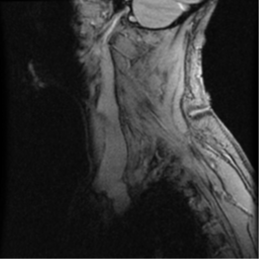 File:Cervical canal stenosis with cord compression (Radiopaedia 34114-35374 D 21).png