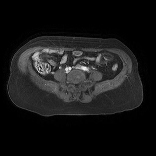 File:Cervical carcinoma (Radiopaedia 67644-77047 Axial T1 C+ fat sat 2).jpg