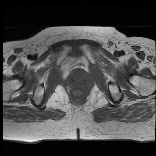 File:Cervical carcinoma (Radiopaedia 70924-81132 Axial T1 16).jpg
