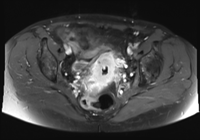 File:Cervical carcinoma (Radiopaedia 88312-104943 Axial T1 C+ fat sat 12).jpg