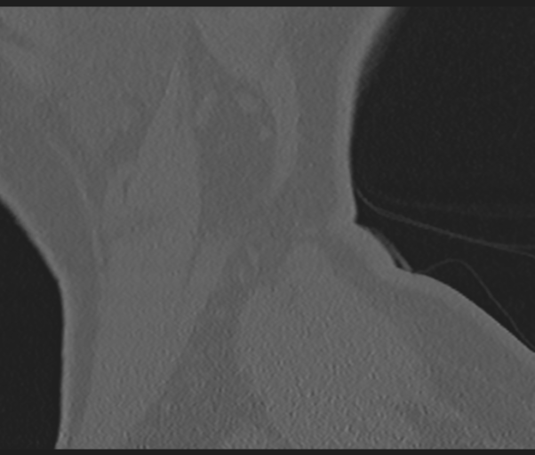 File:Cervical disc replacement (Radiopaedia 44025-47541 Sagittal bone window 2).png