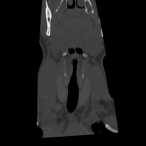 Cervical schwannoma (Radiopaedia 57979-64974 Coronal bone window 12).png