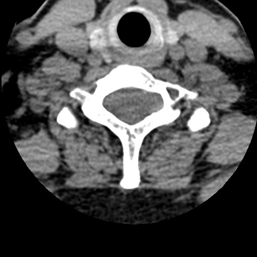 File:Cervical spinal neurofibroma in a patient with NF1 (Radiopaedia 58344-65464 Axial non-contrast 59).jpg