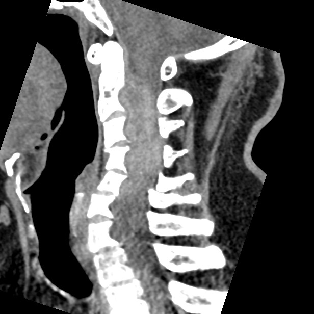 Cervical spinal neurofibroma in a patient with NF1 (Radiopaedia 58344-65464 C 27).jpg