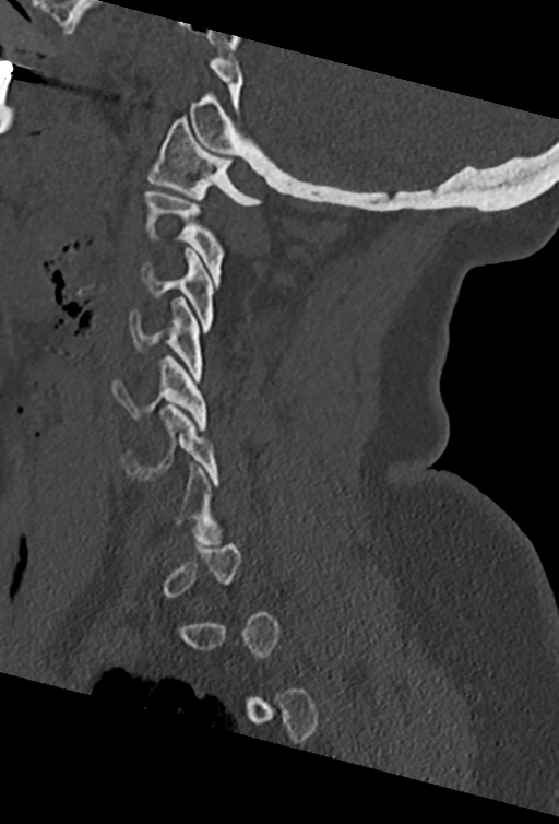 Cervical spine ACDF loosening (Radiopaedia 48998-54070 Sagittal bone window 31).png