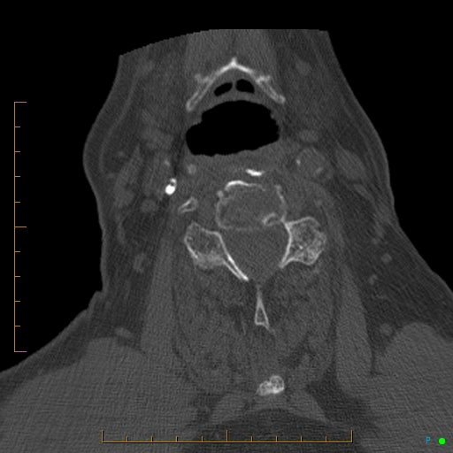 File:Cervical spine fracture - ankylosing spondylitis (Radiopaedia 76835-88706 Axial bone window 120).jpg