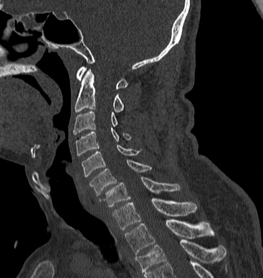 Cervical spine trauma with tear drop fracture and perched facet joint (Radiopaedia 53989-60127 Sagittal bone window 77).jpg