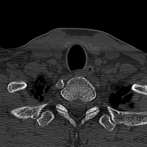 Cervical spondylodiscitis (Radiopaedia 28057-29489 Axial bone window 71).jpg