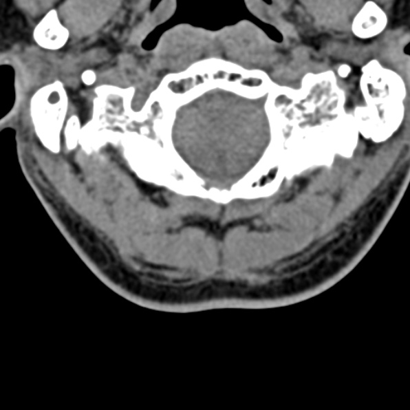 File:Cervical spondylodiscitis (Radiopaedia 28057-29489 Axial non-contrast 11).jpg