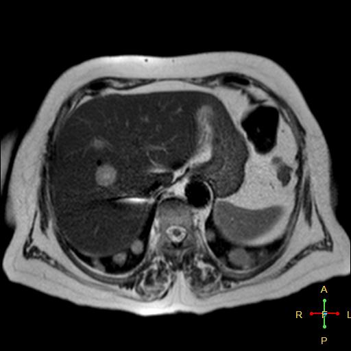 File:Cervical stump squamous cell carcinoma (Radiopaedia 48049-52858 I 14).jpg