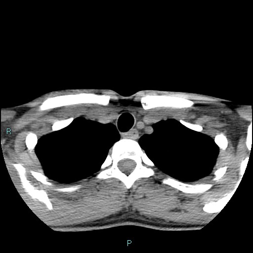 Cervical thymic cyst (Radiopaedia 88632-105335 Axial non-contrast 24).jpg