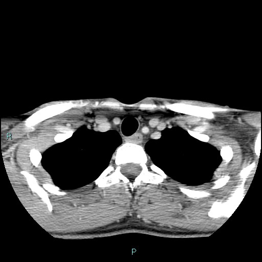 Cervical thymic cyst (Radiopaedia 88632-105335 C 26).jpg