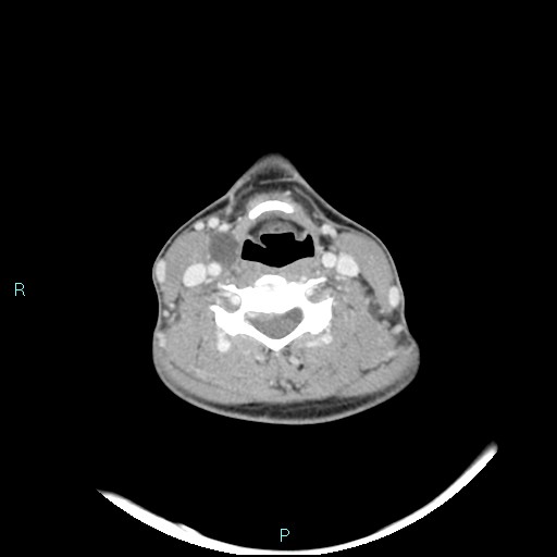 Cervical thymic cyst (Radiopaedia 88632-105335 C 57).jpg