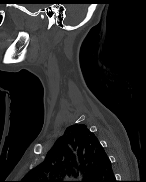 Cervical tuberculous spondylitis (Radiopaedia 39149-41365 Sagittal bone window 10).png