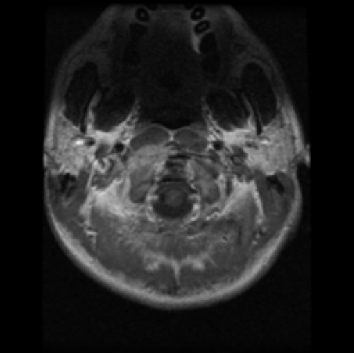 File:Cervical vertebrae metastasis (Radiopaedia 78814-91667 Axial T1 C+ 26).png