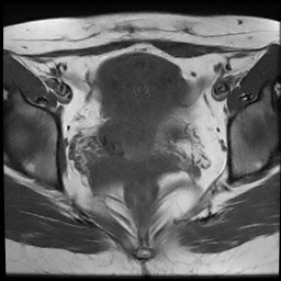 File:Cesarean scar ectopic pregnancy (Radiopaedia 77286-89362 Axial T1 16).jpg