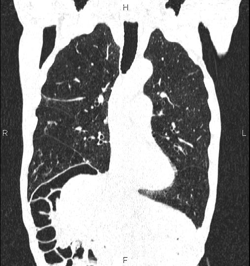 Chilaiditi sign (Radiopaedia 88839-105611 Coronal lung window 26).jpg