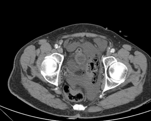 Cholecystitis - perforated gallbladder (Radiopaedia 57038-63916 A 76).jpg