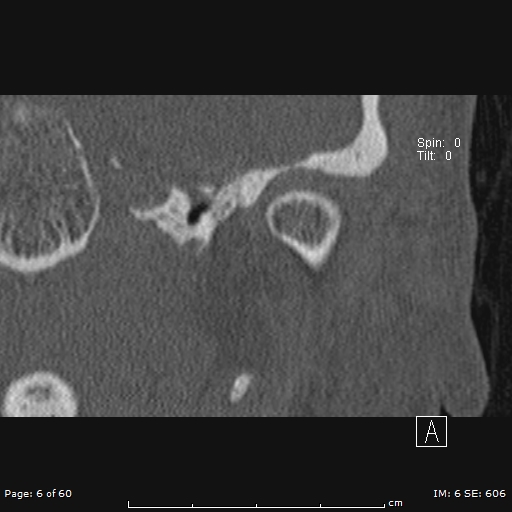 Cholesteatoma - external auditory canal (Radiopaedia 88452-105096 Coronal bone window 6).jpg