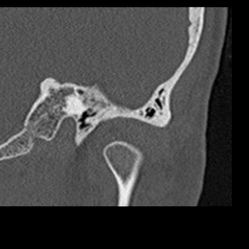 File:Cholesteatoma of the external ear (Radiopaedia 16540-16225 Coronal bone window 4).jpg