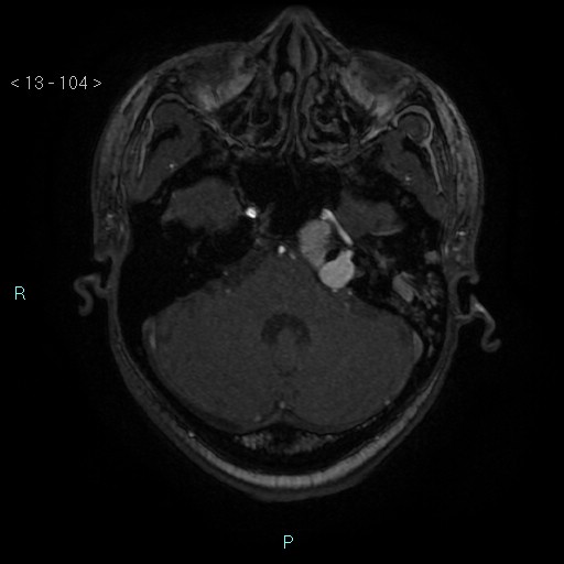 File:Cholesterol granuloma of the petrous apex (Radiopaedia 64358-73140 Axial TOF 3D 50).jpg