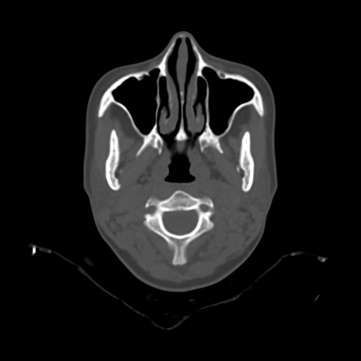 File:Chondroblastic osteosarcoma (Radiopaedia 67363-76741 Axial bone window 3).jpg