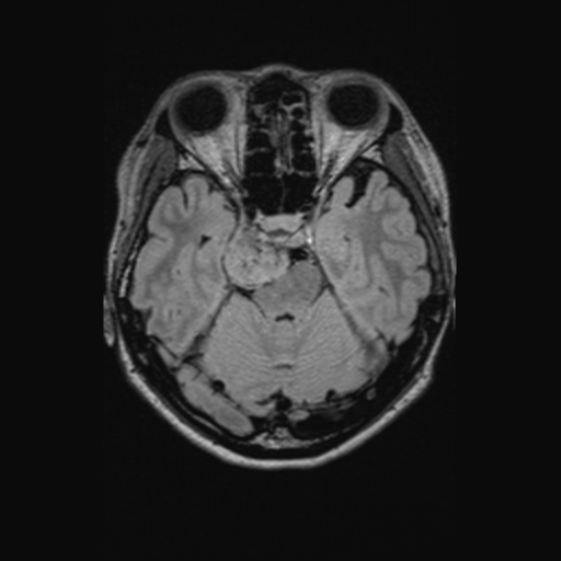 Chondrosarcoma (Radiopaedia 41937-44939 Axial FLAIR 49).png