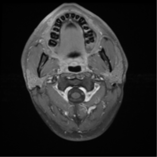 File:Chondrosarcoma (clivus) (Radiopaedia 46895-51424 Axial STIR 2).png