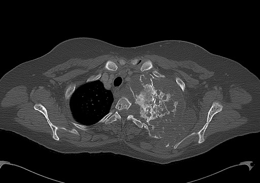 File:Chondrosarcoma - chest wall (Radiopaedia 65192-74199 Axial bone window 24).jpg