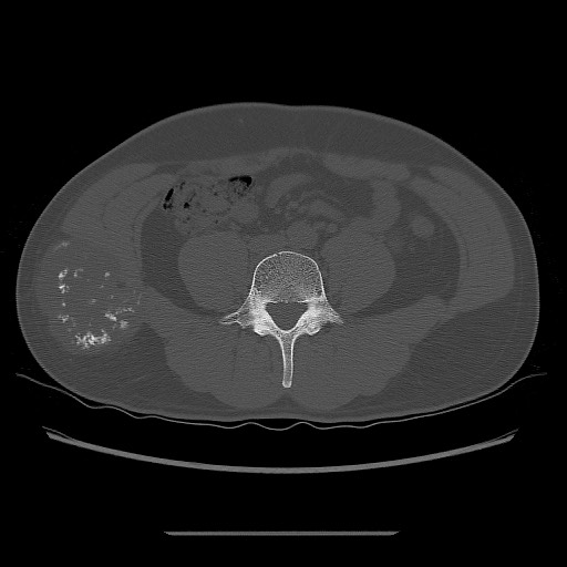 File:Chondrosarcoma of iliac wing (Radiopaedia 63861-72599 Axial bone window 26).jpg