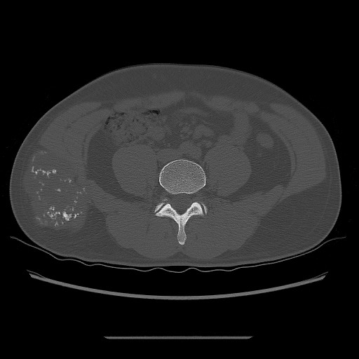 File:Chondrosarcoma of iliac wing (Radiopaedia 63861-72599 Axial bone window 29).jpg