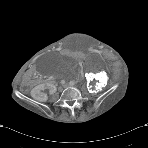 Chondrosarcoma of the spine (Radiopaedia 49871-55143 A 39).jpg