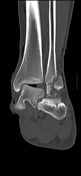 Chopart fracture (Radiopaedia 35347-36851 Coronal bone window 31).jpg
