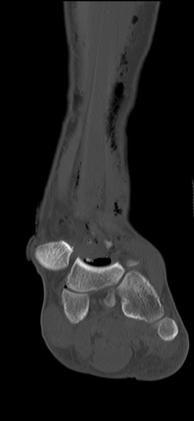 Chopart fracture (Radiopaedia 35347-36851 Coronal bone window 44).jpg