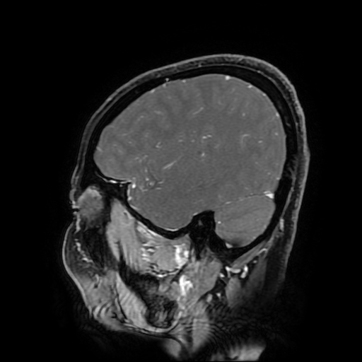 Chordoid glioma of third ventricle (Radiopaedia 91612-109340 F 158).jpg