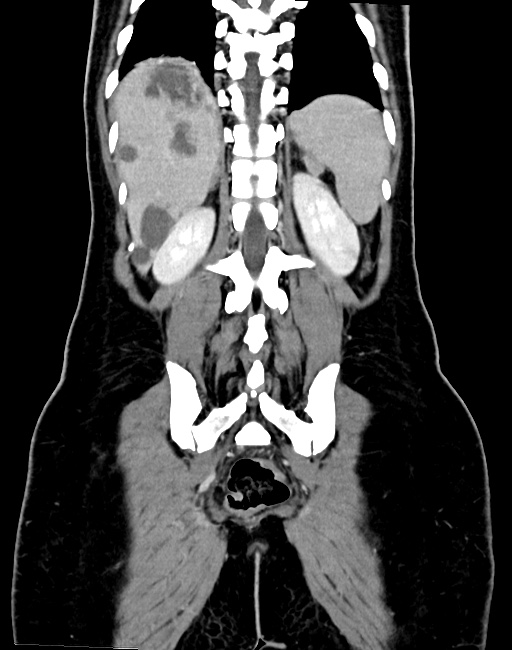 Choriocarcinoma liver metastases (Radiopaedia 74768-85766 B 78).jpg