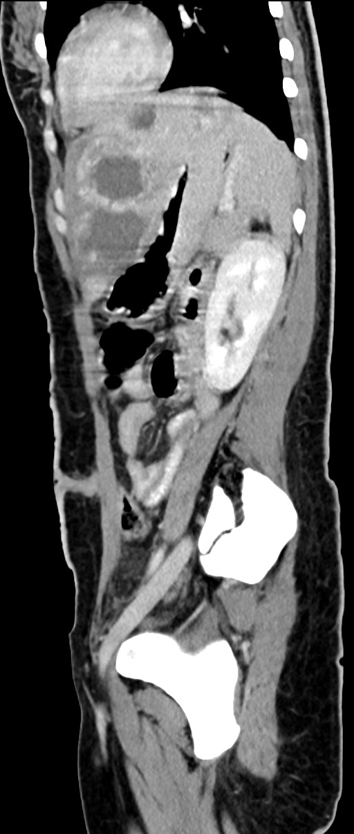 Choriocarcinoma liver metastases (Radiopaedia 74768-85766 C 72).jpg