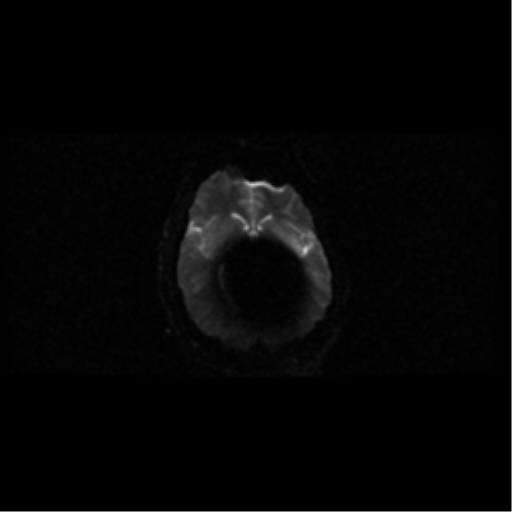 File:Choroid plexus papilloma (Radiopaedia 34951-36441 Axial DWI 41).png