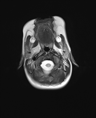 File:Choroid plexus papilloma (Radiopaedia 84612-100019 Axial T2 2).jpg