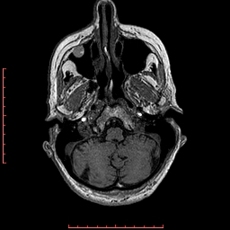 Choroid plexus xanthogranuloma (Radiopaedia 67843-77270 Axial T1 134).jpg