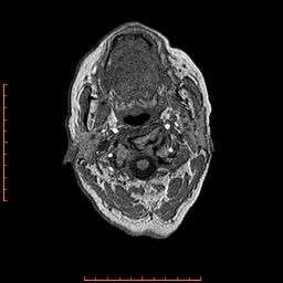 Choroid plexus xanthogranuloma (Radiopaedia 67843-77270 Axial T1 162).jpg