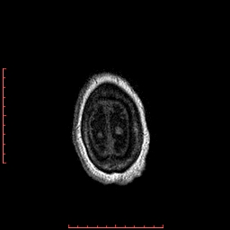 File:Choroid plexus xanthogranuloma (Radiopaedia 67843-77270 Axial T1 21).jpg