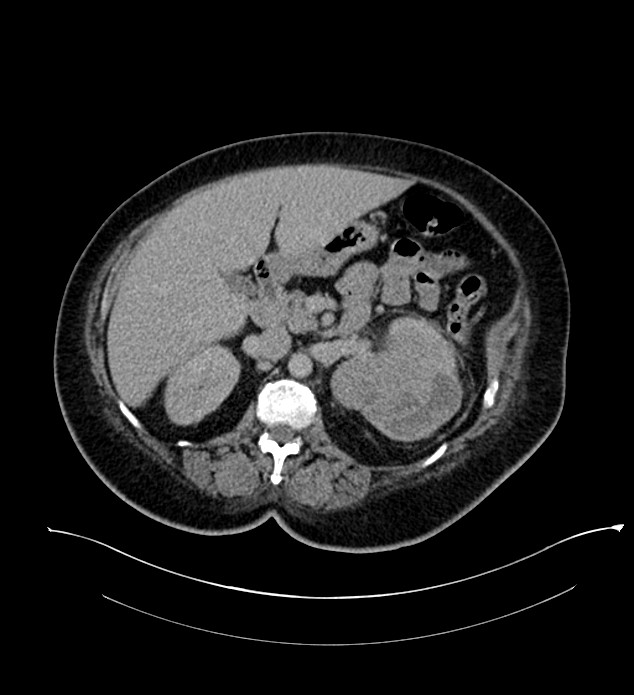 Chromophobe renal cell carcinoma (Radiopaedia 84239-99519 E 68).jpg