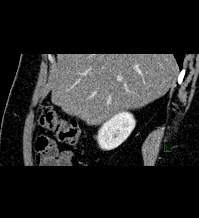Chromophobe renal cell carcinoma (Radiopaedia 84286-99573 F 137).jpg
