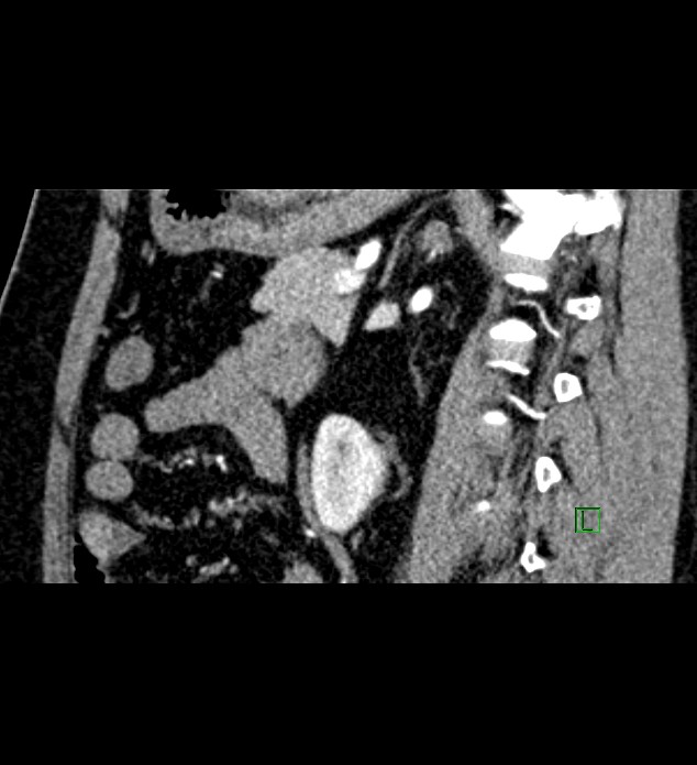 Chromophobe renal cell carcinoma (Radiopaedia 84286-99573 F 67).jpg