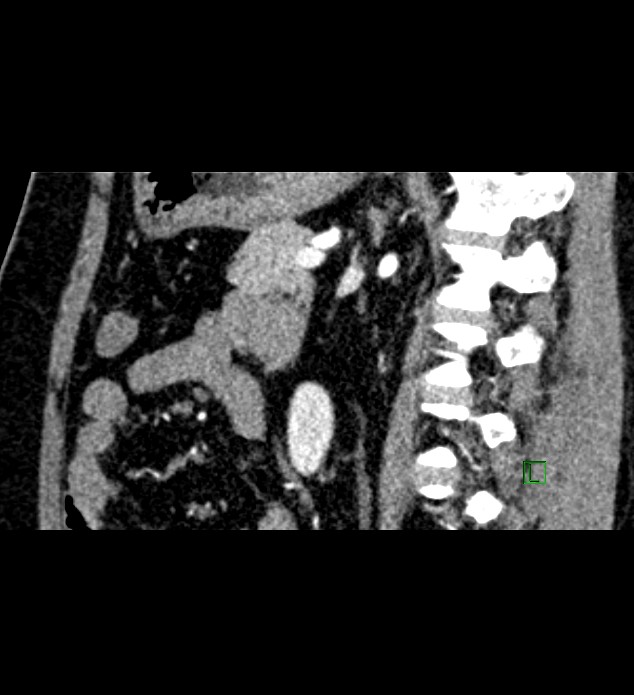 Chromophobe renal cell carcinoma (Radiopaedia 84286-99573 F 69).jpg