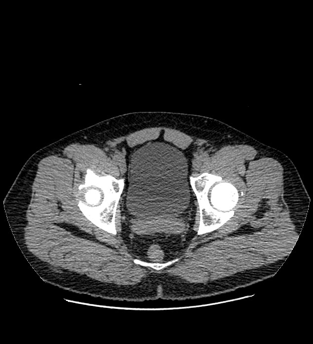 Chromophobe renal cell carcinoma (Radiopaedia 84337-99693 Axial non-contrast 149).jpg