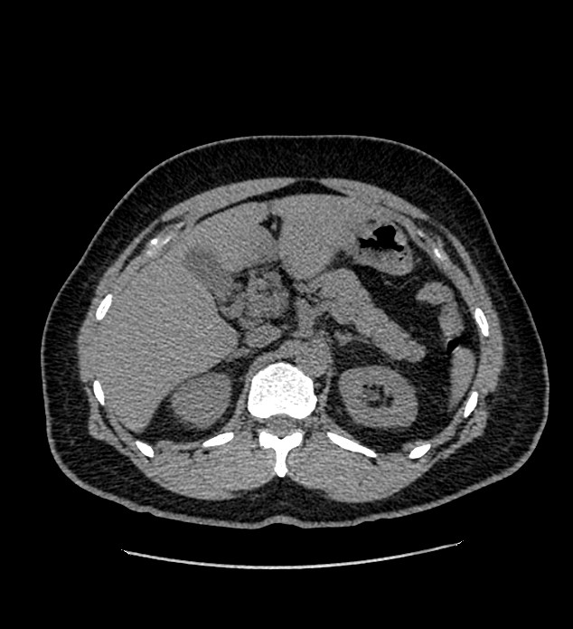 Chromophobe renal cell carcinoma (Radiopaedia 84337-99693 Axial non-contrast 38).jpg