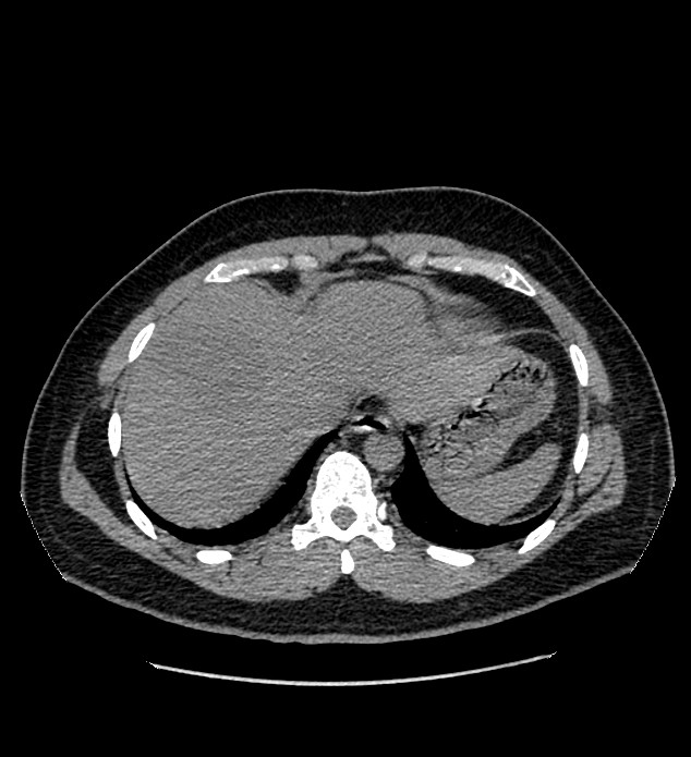Chromophobe renal cell carcinoma (Radiopaedia 84337-99693 Axial non-contrast 8).jpg